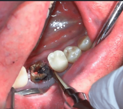 Surgical / Semi-surgical Extraction